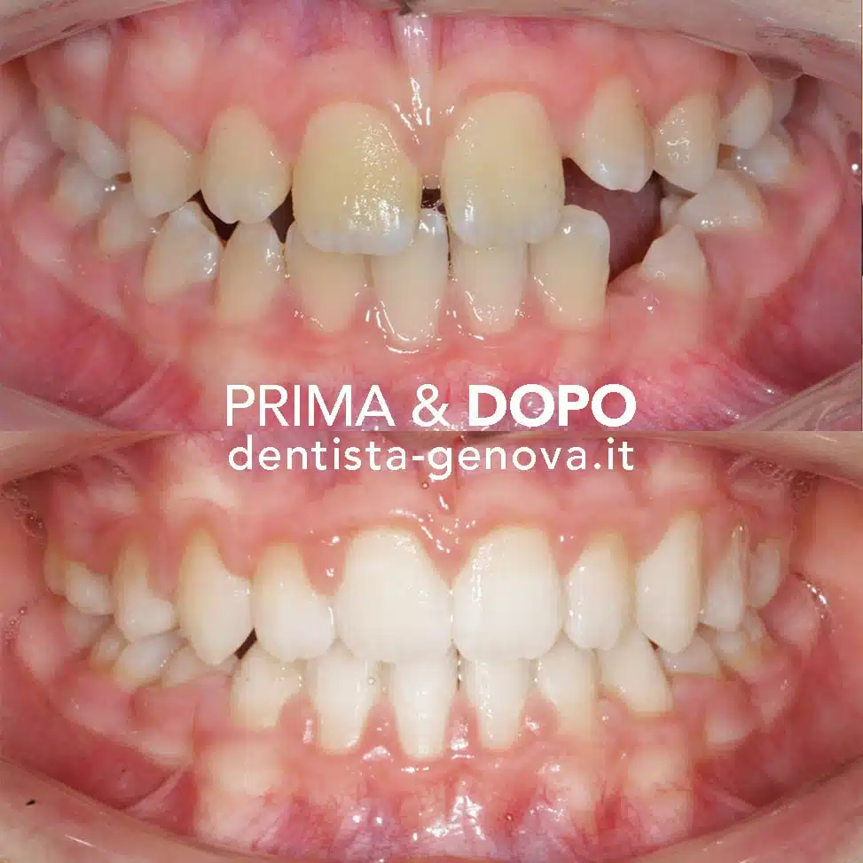 Ortodonzia: risultato prima e dopo 3