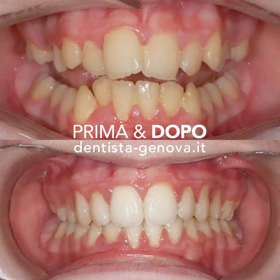 Ortodonzia: risultato prima e dopo 2