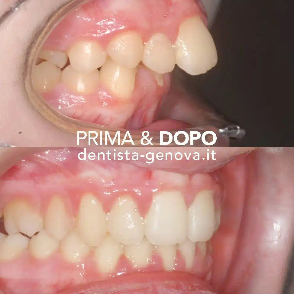 Ortodonzia: risultato prima e dopo 4