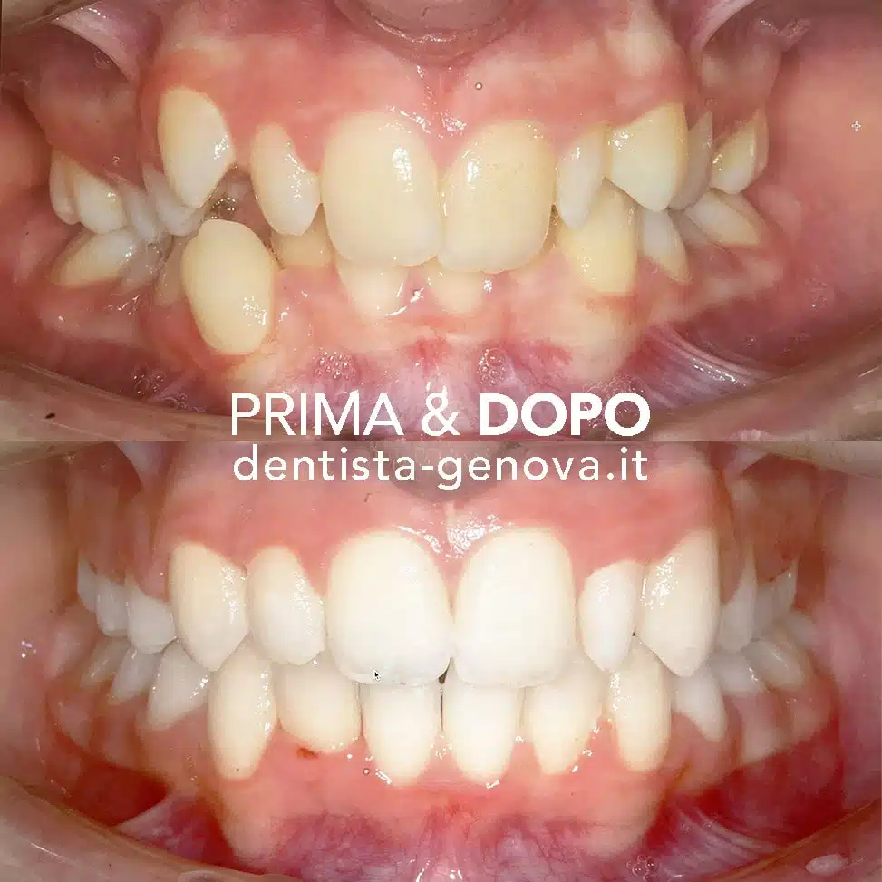 Ortodonzia: risultato prima e dopo 5