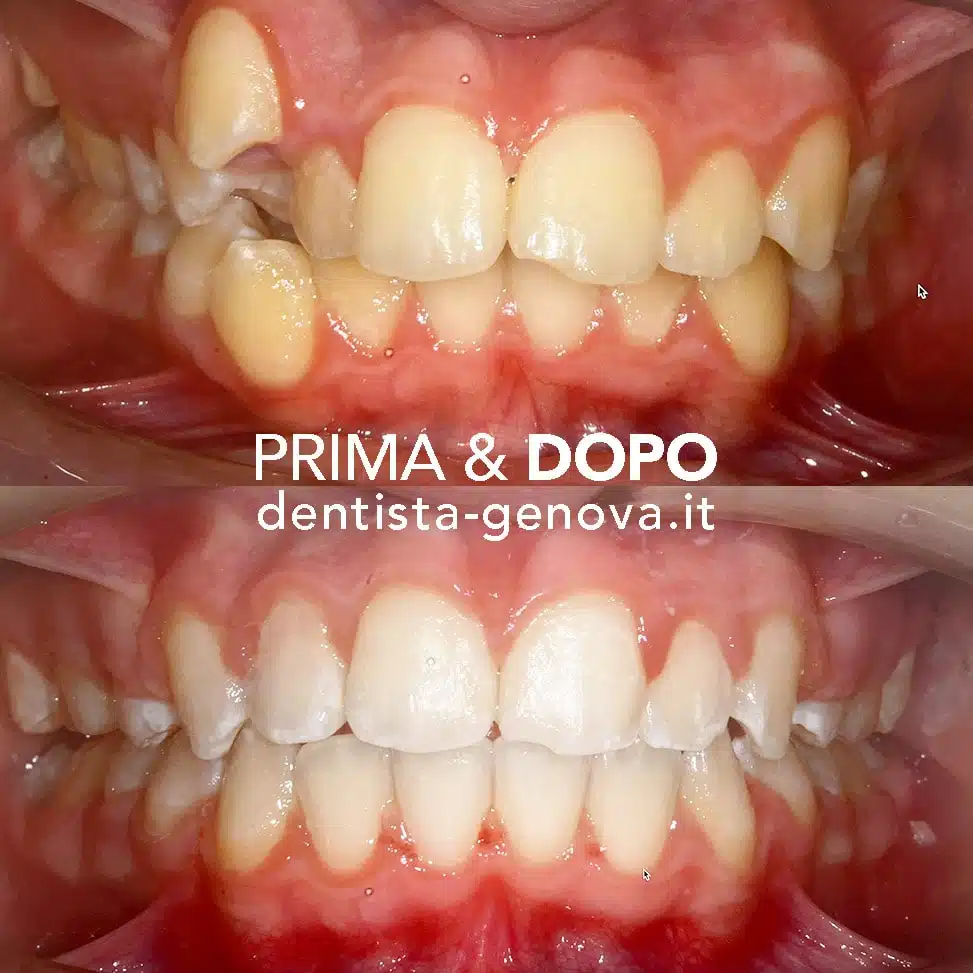 Ortodonzia: risultato prima e dopo 1